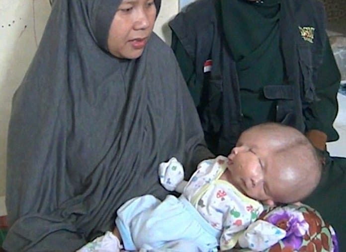 Ребенок с двумя лицами родился в Индонезии